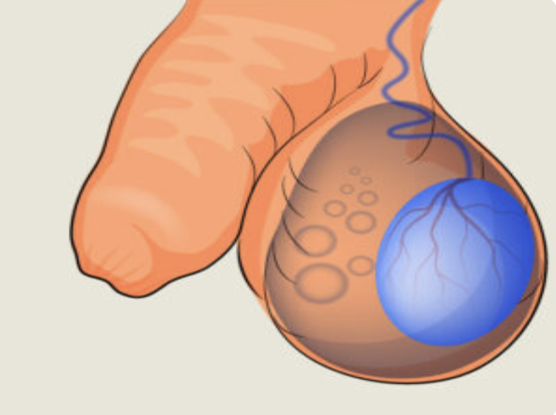 Cataract illustration