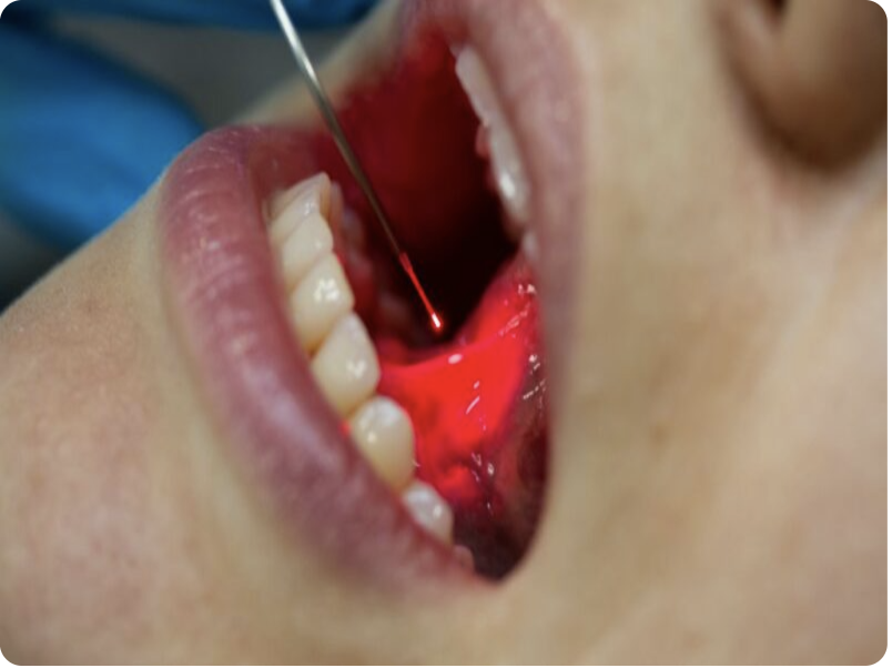 Cataract illustration