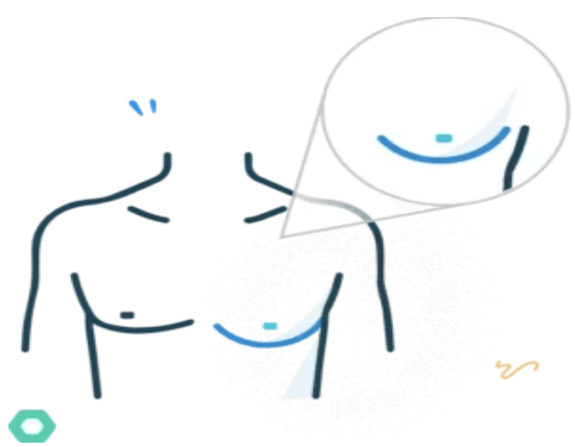 Cataract illustration