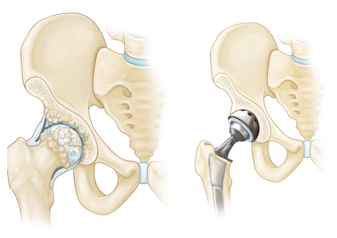 Hip Replacement Surgery