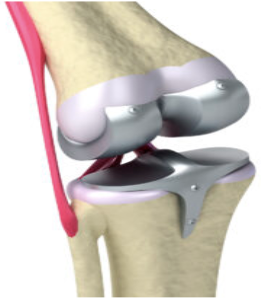 Cataract illustration