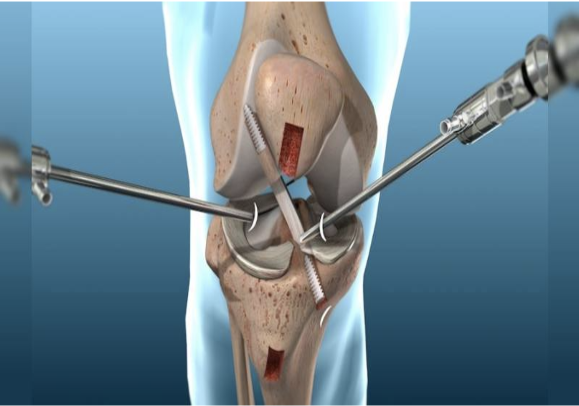 Cataract illustration