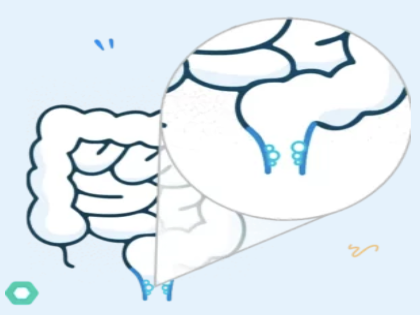 Cataract illustration