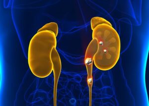 Read more about the article Kidney Stones