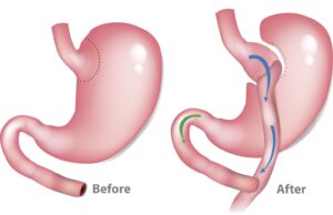 Read more about the article Bariatric Surgery