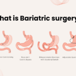 What is Bariatric surgery? Shedding Pounds, Gaining a Life: A Guide to Bariatric Surgery