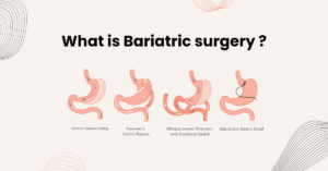 Read more about the article What is Bariatric surgery? Shedding Pounds, Gaining a Life: A Guide to Bariatric Surgery