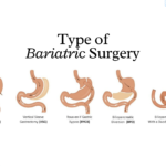 Types of bariatric surgery?Comparing All Weight Loss Surgery Options: Sleeve Gastrectomy, Intragastric Balloon, and Gastric Bypass