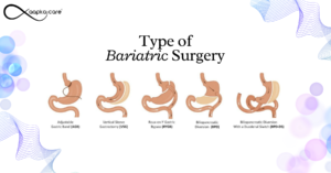 Read more about the article Types of bariatric surgery?Comparing All Weight Loss Surgery Options: Sleeve Gastrectomy, Intragastric Balloon, and Gastric Bypass