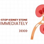 How to stop kidney stone pain immediately