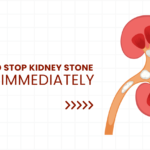 How to pass a kidney stone & 5 tips to prevent them