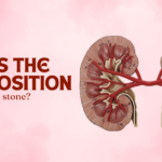 The Best Position to Pass a Kidney Stone