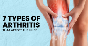 Read more about the article Understanding the 7 Types of Arthritis That Affect the Knee