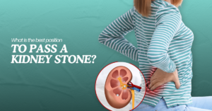 Read more about the article What Is the Best Position to Pass a Kidney Stone?