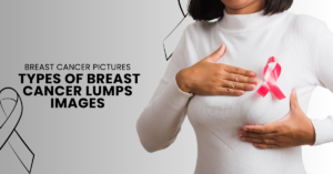 Read more about the article Breast Cancer Pictures – Types of Breast Cancer Lumps Images