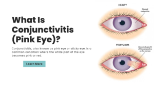 Read more about the article What Is Conjunctivitis (Pink Eye)?