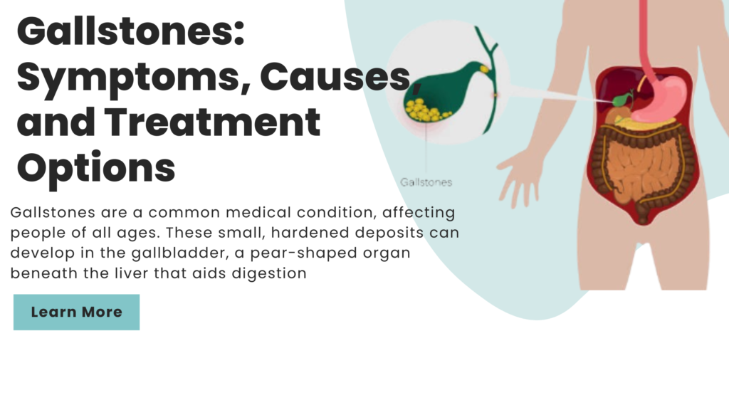 Gallstones: Symptoms, Causes, and Treatment Options