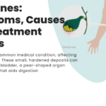 Gallstones: Symptoms, Causes, and Treatment Options