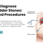 How to Diagnose Gallbladder Stones: Tests and Procedures