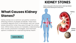 Read more about the article What Causes Kidney Stones?