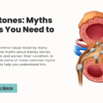 Kidney Stones: Myths and Facts You Need to Know