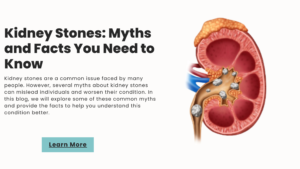 Read more about the article Kidney Stones: Myths and Facts You Need to Know