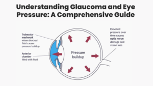 Read more about the article Understanding Glaucoma and Eye Pressure: A Comprehensive Guide