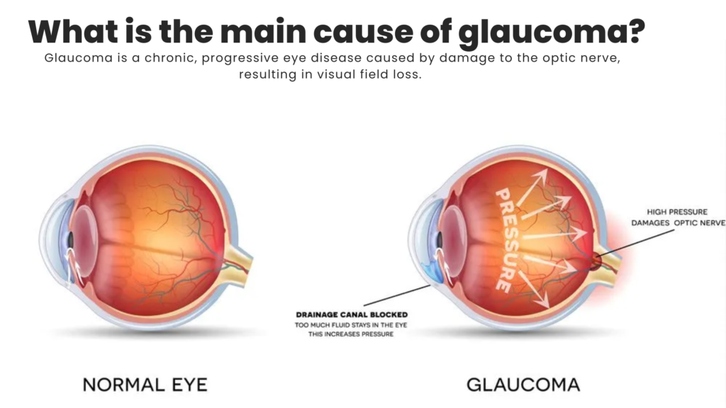 What is Glaucoma?