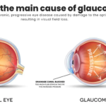 What is glaucoma?