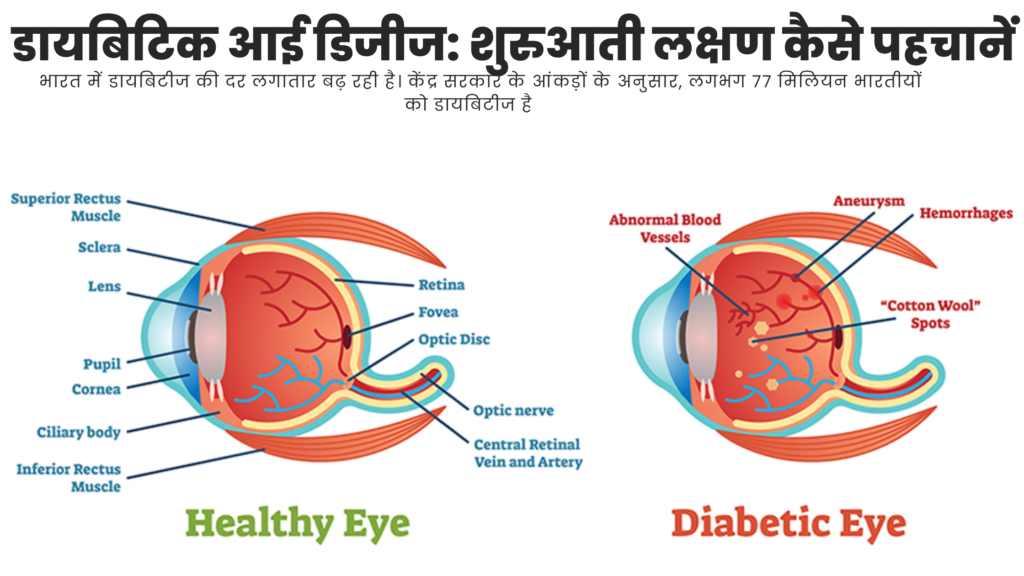 डायबिटिक आई डिजीज: शुरुआती लक्षण कैसे पहचानें