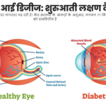 डायबिटिक आई डिजीज: शुरुआती लक्षण कैसे पहचानें