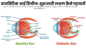 Read more about the article डायबिटिक आई डिजीज: शुरुआती लक्षण कैसे पहचानें