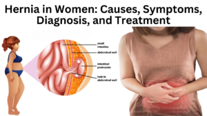 Read more about the article Hernia in Women: Causes, Symptoms, Diagnosis, and Treatment